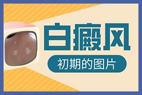 1661154751323786.jpg 84白癜风初期的图片.jpg